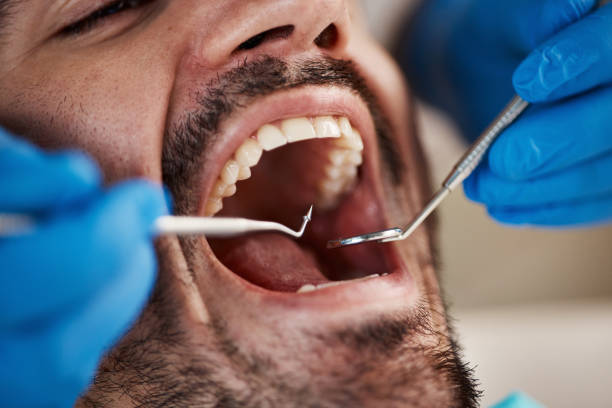 Best Emergency Tooth Extraction in Oakland, OR