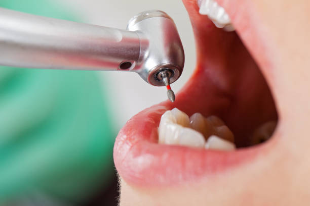 Best Urgent Care for Lost Fillings or Crowns in Oakland, OR